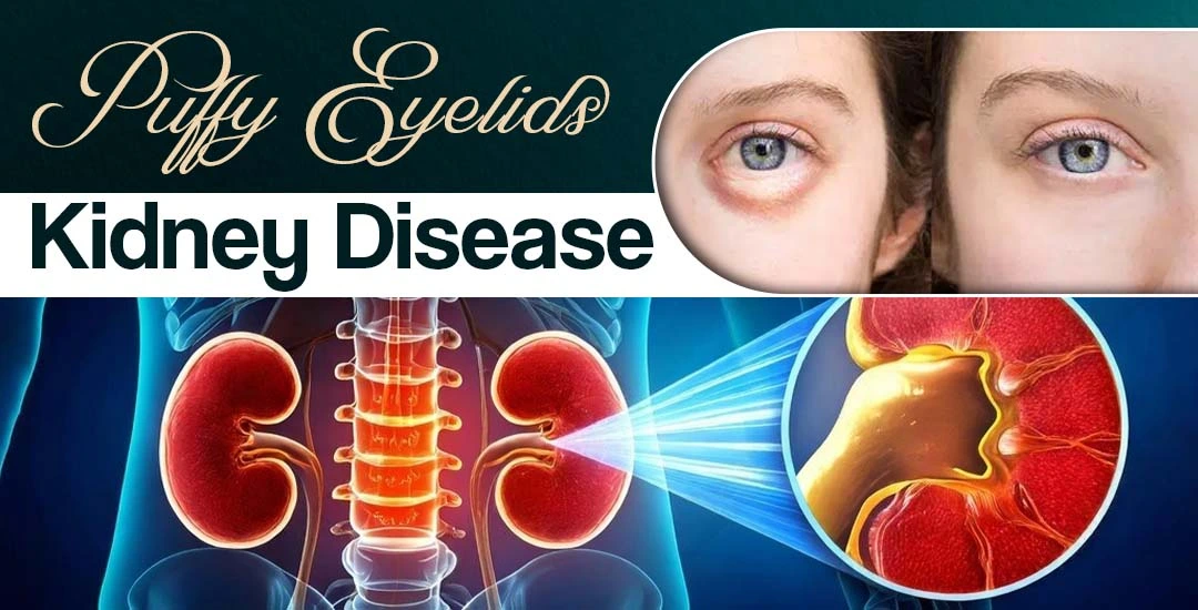 Puffy Eyelids and Kidney Disease: An Early Warning Sign You Shouldn’t Ignore